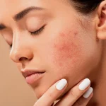 How to Reduce Acne Scars Naturally