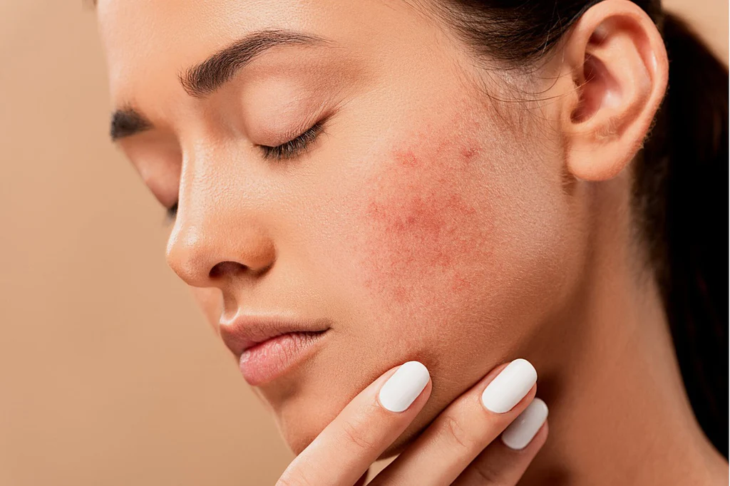 How to Reduce Acne Scars Naturally: Proven Remedies for Clearer Skin